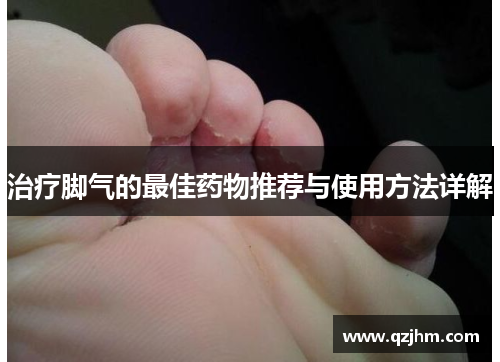 治疗脚气的最佳药物推荐与使用方法详解